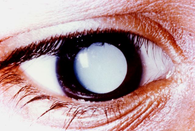 Cataract