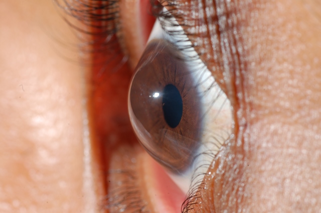 Cornea