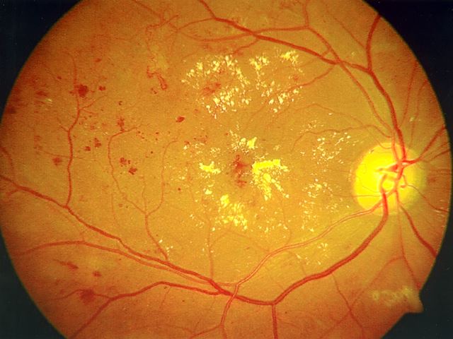 Retina & Vitreous